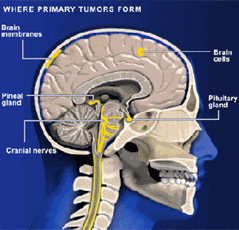 Chart of sections in brain where tumors stem from