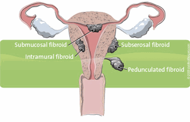 Learn more about myomectomy for treatment of uterine fibroids with the da Vinci® robotic surgical system at Methodist Dallas and Methodist Richardson medical centers.